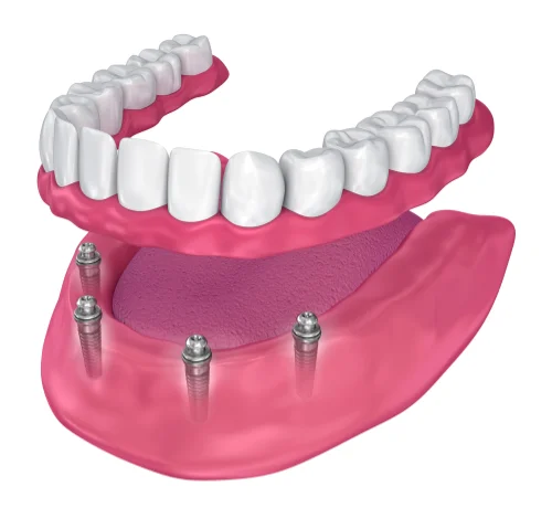 graphic illustration of a lower denture with implants