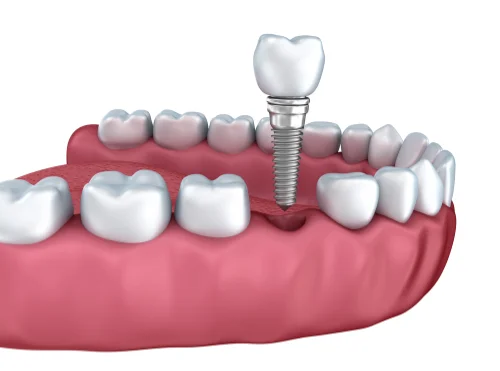 grapic illustration of a single tooth implant