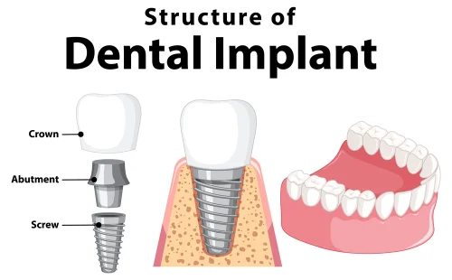 graphic illustration of the structure of a dental implant