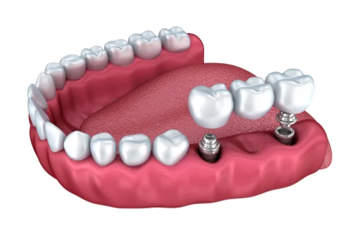 grapic illustration of two implants supporting a bridge